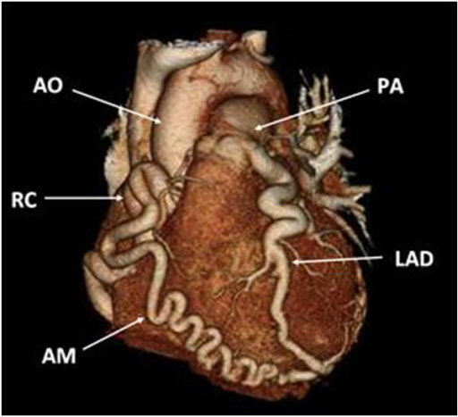 cta-3d-reconstruction-of-the-heart-aorta-ao-right-c-open-i