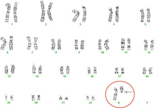 turner syndrome research paper turner syndrome research paper