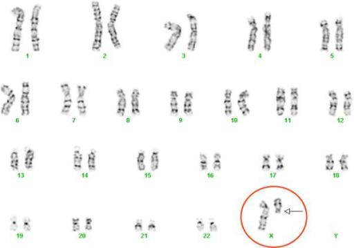 Кариотип 45. Синдром Шерешевского Тернера кариотип. Синдром Шерешевского Тернера хромосомы. Кариотип женщины с синдромом Шерешевского Тернера. Болезнь Шерешевского-Тернера кариотип.