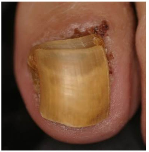 Case Report: Onychodystrophy From Late-Onset Congenital Malalignment of the  Great Toenails | AAFP