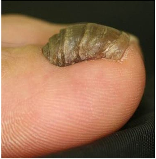Above) Partial fingernail defect after trauma. (Center) Excision of... |  Download Scientific Diagram
