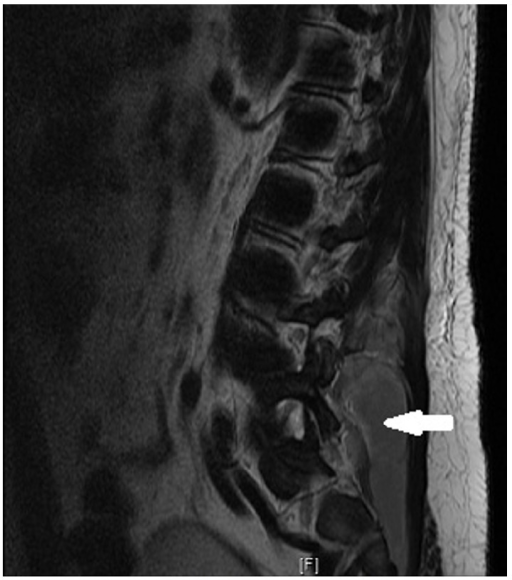 MRI of Dorso-lumbar spine, Case 1. Sagittal section showing epidural