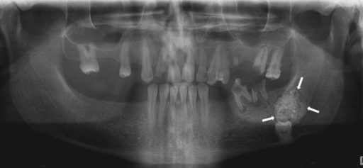 A Calcifying Epithelial Odontogenic Tumor Is Seen In Th Open I