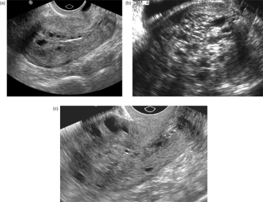 (a,b,c) Sagittal transvaginal ultrasound images from th | Open-i