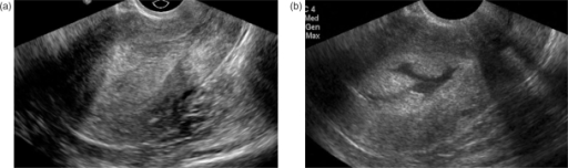 Hysterosonography as an adjunct to transvaginal ultraso | Open-i