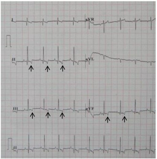 Canine ECG during sinus rhythm with deep T waves invers | Open-i