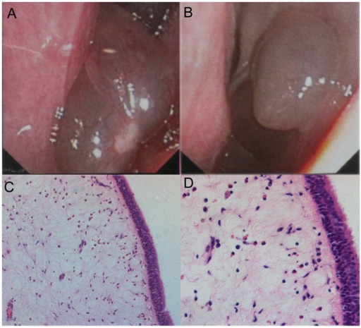 Histological analysis showing the types of nasal polyps Open