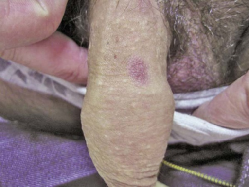 Lesion On Penis 98