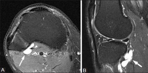 Popliteus Ganglion. A 34-year-old Woman With Knee Pain. 