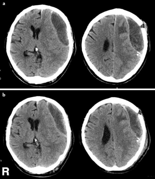 a Plain CT scans demonstrate the recurrence of the left | Open-i