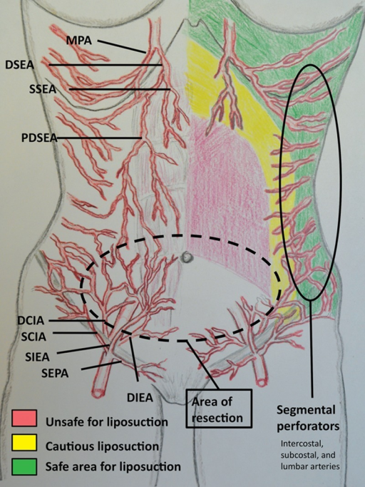 After elevation of the abdominal flap during traditiona | Open-i