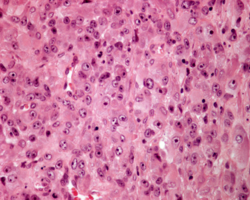 Histology of metastatic amelanotic melanoma to the thyr | Open-i