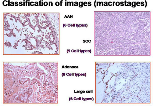 Example of cell types in histological images of lung di | Open-i