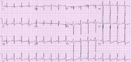 Electrocardiogram showing abnormal ST-T wave, biatrial | Open-i