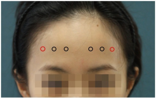 proposed injection points of bont a on the frontalis mu open i
