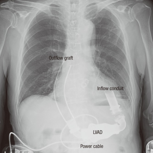 Impella Chest X Ray