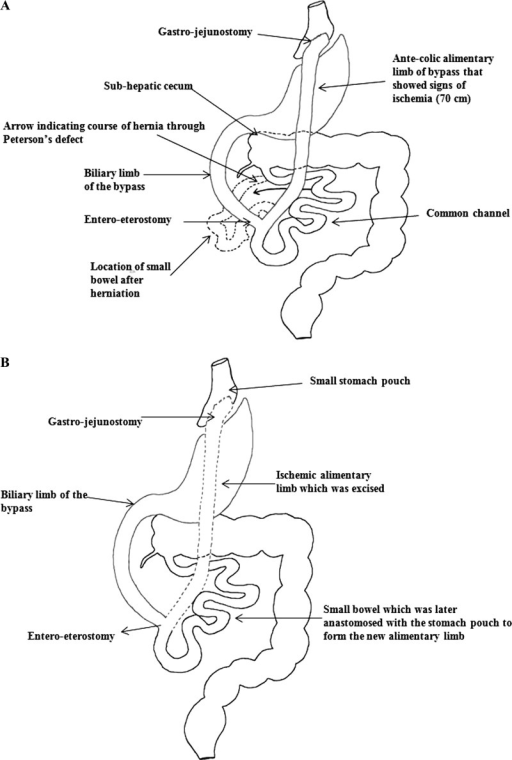 (A) Malrotated midgut with subhepatic location of the c | Open-i