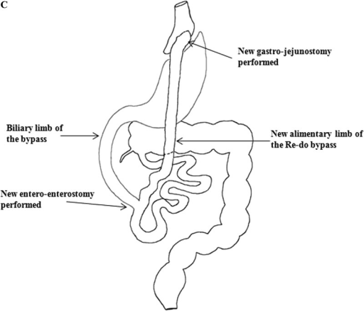 (A) Malrotated midgut with subhepatic location of the c | Open-i