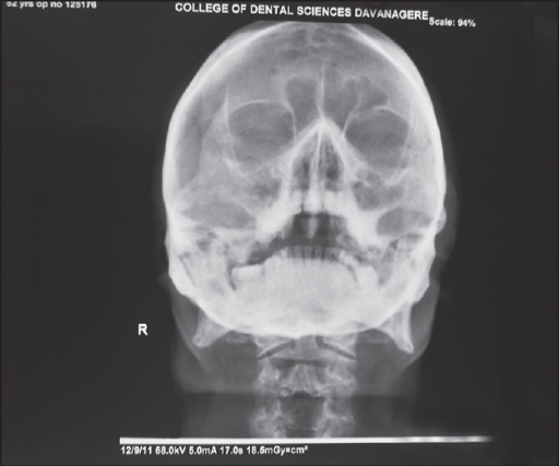 Water's view showing haziness in right maxillary sinus | Open-i