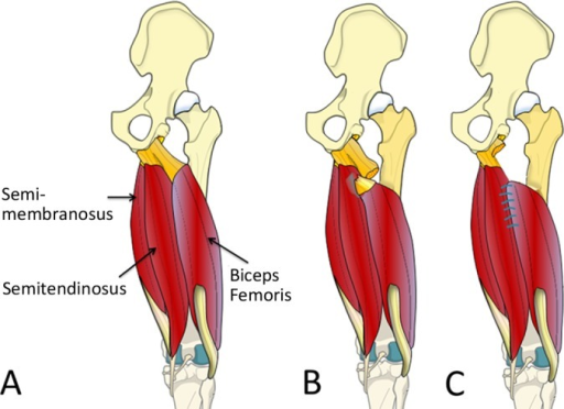 Proximal lesion. (A) Schematic representation of the ha | Open-i