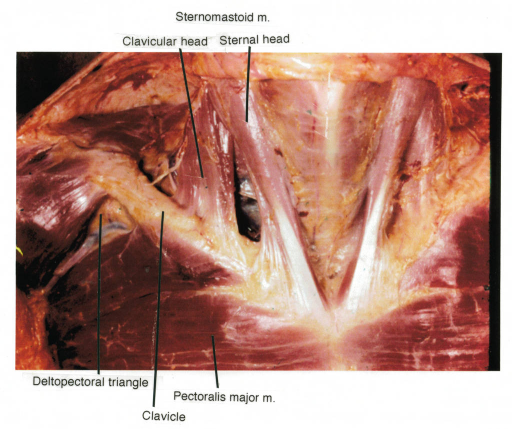 sternomastoid muscle; clavicle; sternum; deltopectoral | Open-i