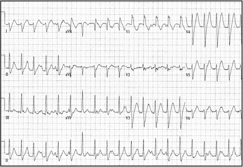 ECG demonstrating AV Dissociation (see lead II rhythm s | Open-i