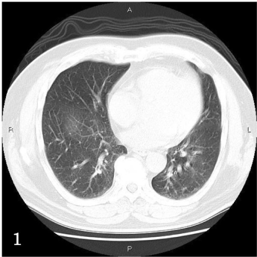 Chest CT. Diffuse reticular opacities are seen in both | Open-i