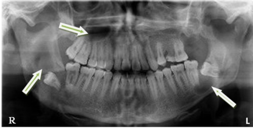 Panoramic view showing multiple radiolucent lesions in | Open-i