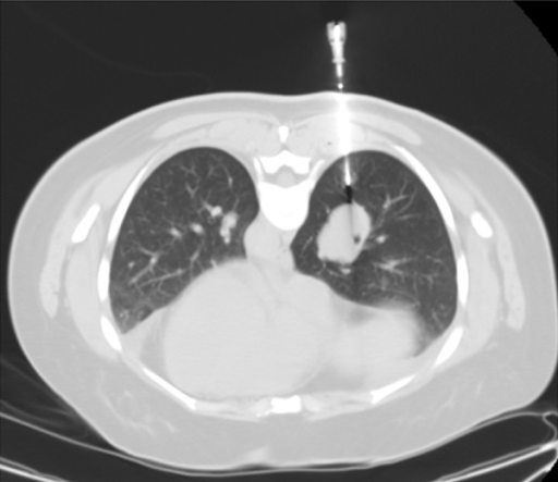 Ct Guided Biopsy Of The Right Infrahilar Mass Open I 3028