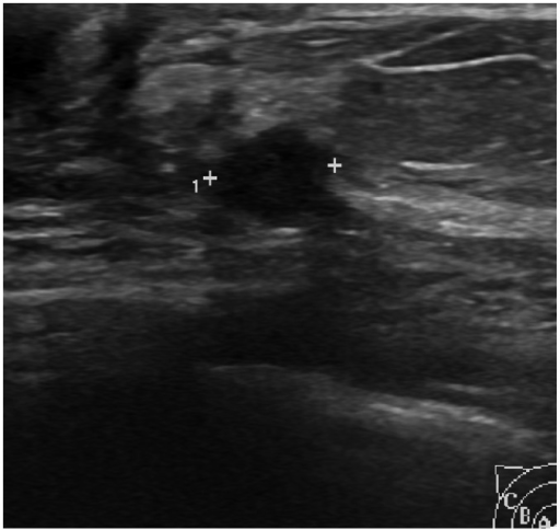 Intraductal papilloma in 44-year-old woman.Transverse u | Open-i