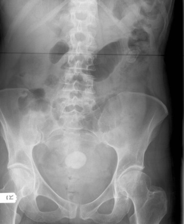 Abdominal X-ray. The X-ray shows air in the biliary tre | Open-i