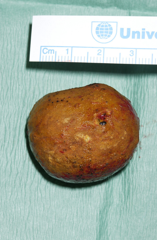 gallstone-the-gallstone-measured-3-cm-in-size-open-i