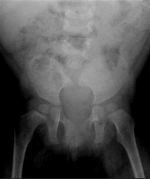 Caudal regression syndrome (complete agenesis of sacrum | Open-i