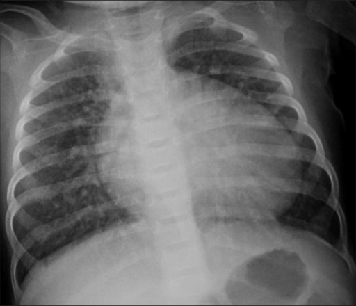 Ventricular septal defect (VSD): Cardiomegaly with plet | Open-i