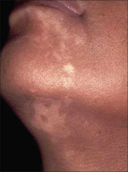 Unilateral depigmentation (segmental vitiligo) on the n | Open-i