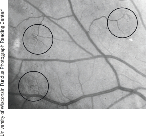 Intraretinal Microvascular Abnormalities Irma The Ci Open I