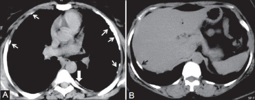 Mesothelioma And Pleural Plaques: (A) Axial Plain CT Sc | Open-i