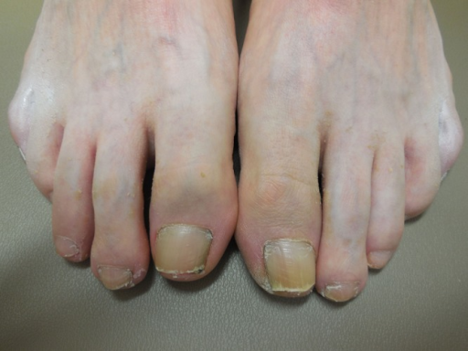 Clinical presentation of terra firma-forme dermatosis i | Open-i