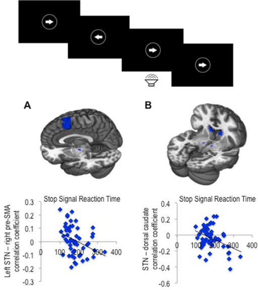 Subthalamic nucleus connectivity in binge drinkers and