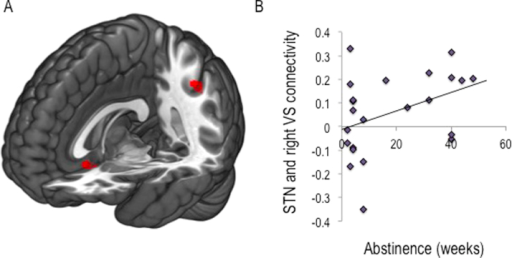 Subthalamic nucleus connectivity in binge drinkers and