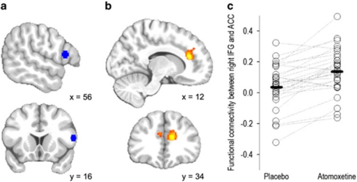 Whole Brain Seed Correlation Comparing Right Inferior F Open I Whole Brain Seed Correlation Comparing Right Inferior F Open I