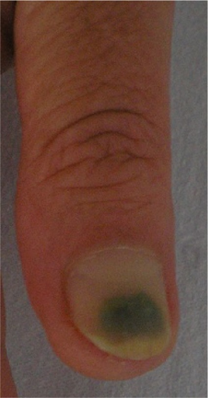 Onycholysis And Secondary Pseudomonas Aeruginosa Infect Open I Onycholysis And Secondary Pseudomonas Aeruginosa Infection Of The Finger Nail In A 68 Year