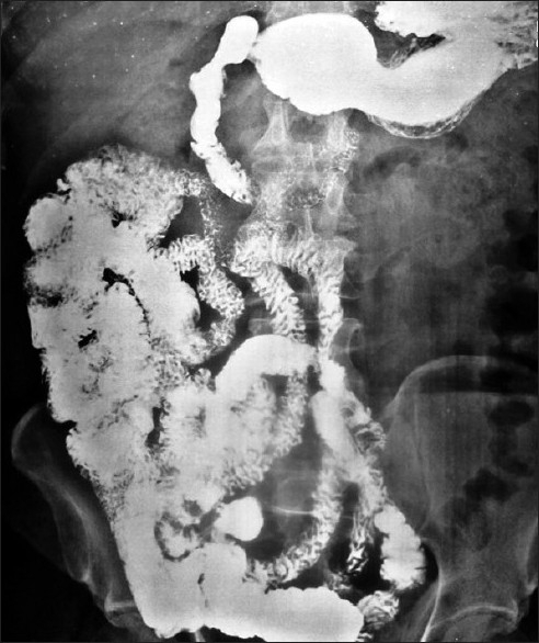 Barium meal follow-through in the 70-year-old patient w | Open-i