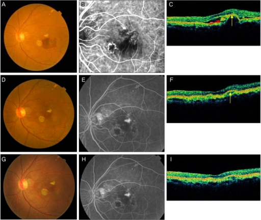 Polypoidal Choroidal Vasculopathy In The Left Eye Of A Woman 61 Years Age Fundus Polypoidal Choroidal Vasculopathy In The Left Eye Of A Woman 61 Years Age Fundus
