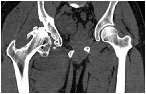 The Ct Scan Coronal Cut Demonstrates Numerous Osteophyt Open I