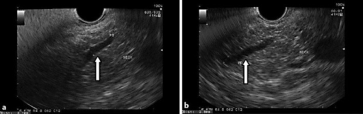 A, B Eus Images Showing An Abnormal Pancreatic Duct At 