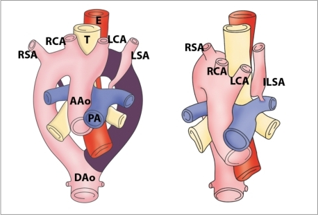 Diagram of development of right aortic arch with isolat | Open-i