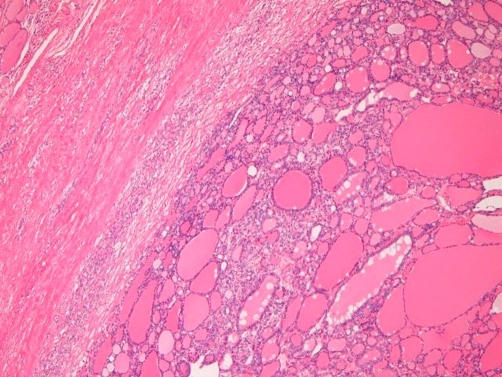 Follicular adenoma: The parenchyma is composed of normo ...

