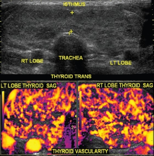 Thyroid Sonography In A Graves Disease Patient The Open i