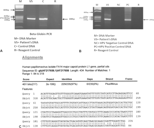 A The Patient S Dna Was Positive With B Globin Pcr Ass Open I